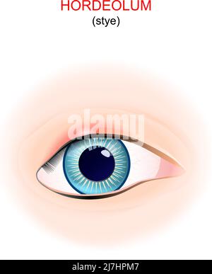 stye. Primo piano dell'occhio umano con l'ordeolo sulla palpebra superiore. Illustrazione vettoriale Illustrazione Vettoriale