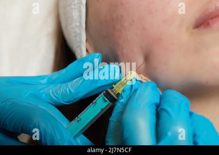 Siringa con plasma sanguigno di un paziente in una mano di un cosmetologo per un plasmolifting della pelle del viso di una donna. Plasma terapia, il ripristino delle cellule della pelle Foto Stock