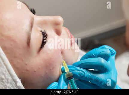Siringa con plasma sanguigno di un paziente in una mano di un cosmetologo per un plasmolifting della pelle del viso di una donna. Plasma terapia, il ripristino delle cellule della pelle Foto Stock