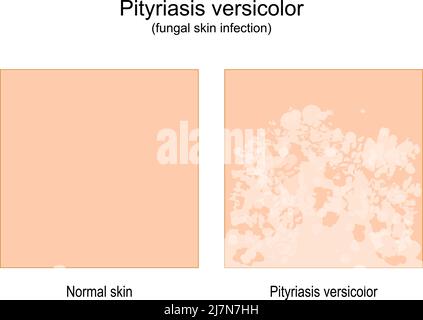 Pityriasis versicolor. Infezione della pelle fungina. Confronto di pelle sana e tinea versicolor. Illustrazione vettoriale Illustrazione Vettoriale