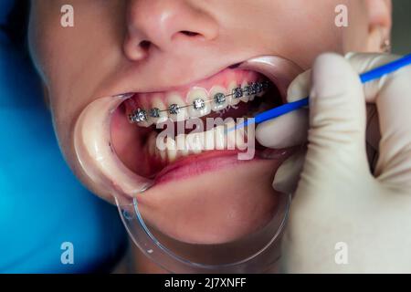 Bocca aperta dentale femmina con rinforzi in gel fissatore alla reception.Bracket System kappa close up Foto Stock