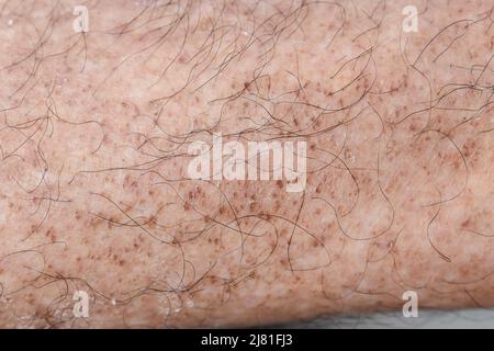 Macchie di età sulla gamba dell'anziano asiatico. Le macchie di età sono marrone, grigio, o macchie nere e anche chiamato macchie di fegato, lentigine senile, lentigine solari, o sole s Foto Stock