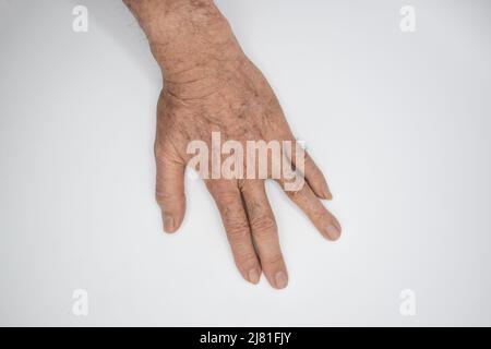 Mano spastica. Spasticità del muscolo della mano. Concetto di salute delle mani. Foto Stock