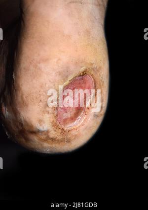 Ulcera del piede del diabete nel piede del paziente asiatico. Primo piano. Foto Stock