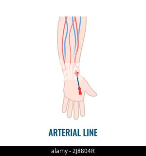 Catetere per linea arteriosa, illustrazione Foto Stock