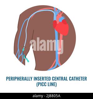 Dispositivo PICC per infusione endovenosa, illustrazione Foto Stock