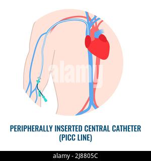 Dispositivo PICC per infusione endovenosa, illustrazione Foto Stock