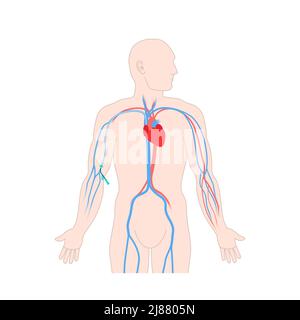 Dispositivo PICC per infusione endovenosa, illustrazione Foto Stock