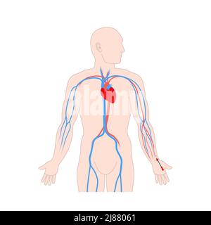 Catetere per linea arteriosa, illustrazione Foto Stock