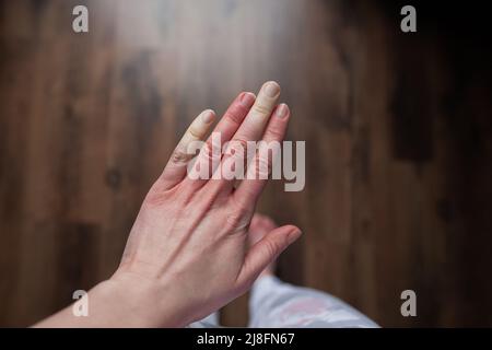 Mano di persona con fenomeno di Raynaud durante l'attacco con alcune dita diventare bianco, cambiamento di colore della pelle sindrome di Raynaud malattia di Raynaud Foto Stock