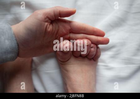 Persona con sindrome di Raynaud ed Ehlers-Danlos che tiene il piede con le punte gonfie, molto asciutto, flaky, closeup della pelle danneggiato Foto Stock