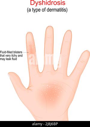 Disidrosi tipo di dermatite con vesciche pruriginose sui palmi delle mani. Vesciche piene di liquidi molto prurito. Illustrazione vettoriale Illustrazione Vettoriale