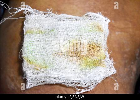 Tampone umido in garza di cotone con colorazione verde e marrone con infezione da Clostridium difficile. Copre l'ascesso post-operatorio della ferita di iniezione. Dail Foto Stock