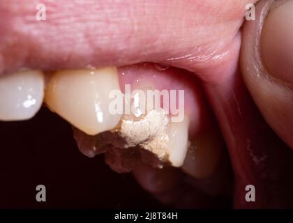 Riempimento dei denti con cemento temporaneo per il trattamento del canale radicolare. Rimozione dei nervi dentali, preparazione per protesi Foto Stock