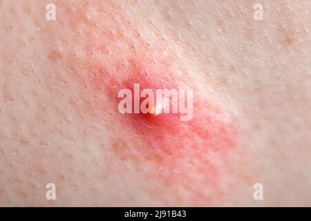 acne sulla pelle umana infiammata, salute del corpo teen e problemi di rosso pimple primo piano-up struttura della pelle umana. Foto Stock