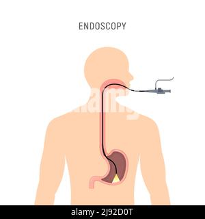 Illustrazione vettoriale dell'apparecchiatura di anatomia dello stomaco per endoscopia. Esame del corpo dell'endoscopio esofageo, strumento umano per gastroscopia Illustrazione Vettoriale