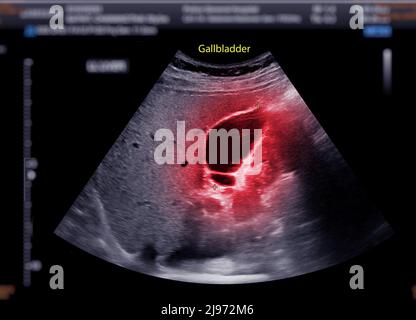 Ecografia dell'addome superiore che mostra la cistifellea per la diagnosi calcoli della cistifellea. Foto Stock