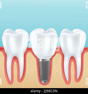 Protesi dentarie rappresentazione vettoriale realistica con denti sani e protesi dentarie corona impiantata con impianti Illustrazione Vettoriale