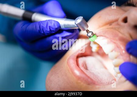 Dentista irriconoscibile che utilizza una spazzola per lucidatura dentale per lucidare e pulire i denti di una paziente Foto Stock