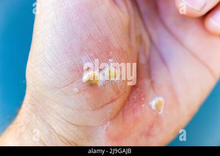 Tagliare le ferite su una mano, sanguinando, con bolle bianche dal perossido di idrogeno per guarirlo. Foto Stock