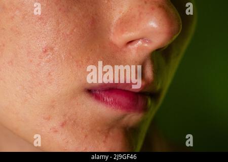 post-acne, cicatrici e rosso festeggiamento pimples sulla faccia di una giovane donna. concetto di problemi della pelle e fallimento armonico Foto Stock