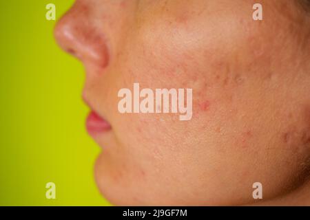 post-acne, cicatrici e rosso festeggiamento pimples sulla faccia di una giovane donna. concetto di problemi della pelle e fallimento armonico Foto Stock