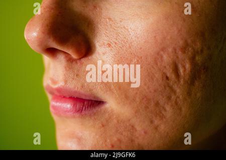 post-acne, cicatrici e rosso festeggiamento pimples sulla faccia di una giovane donna. concetto di problemi della pelle e fallimento armonico Foto Stock