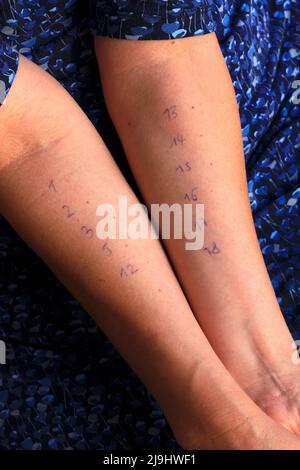 Mani di donna con numeri di test allergici Foto Stock