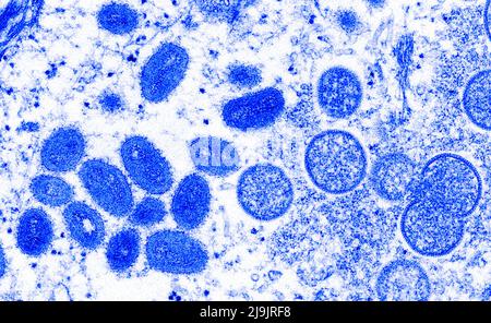 VIRUS MONKEYPOX. Questa immagine microscopica elettronica (EM) raffigura un virione scimmipox, ottenuto da un campione clinico associato con l'epidemia di cane prateria 2003. Era un'immagine di sezione sottile da un campione di pelle umana. A sinistra erano particelle virali mature di forma ovale, e a destra erano i mezzentri, e le particelle sferiche di virioni immaturi. Foto Stock