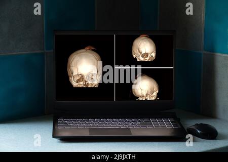 3d tomografia computerizzata del cervello con una frattura della parte frontale del cranio dopo ferita sugli schermi del laptop sul tavolo, il cranio Foto Stock