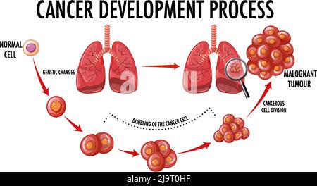 Diagramma che mostra l'illustrazione del processo di sviluppo del cancro Illustrazione Vettoriale