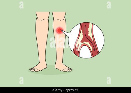 Il primo piano della persona soffre di MALATTIA DEL TAMPONE che ha ostruzione del vaso sanguigno nelle gambe. L'uomo lotta con gli arti coagulati dalle vene che si restringono o si bloccano. Concetto di assistenza sanitaria. Illustrazione vettoriale. Illustrazione Vettoriale