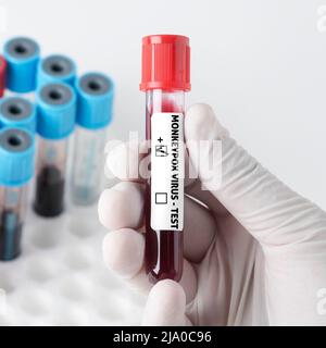 Medico che tiene una provetta per l'analisi del sangue per il virus della scimmietta Foto Stock