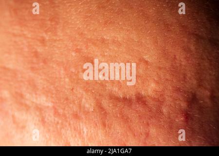 post-acne, cicatrici e punture rosse sul volto di una giovane donna. Foto Stock