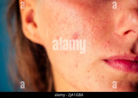 post-acne, cicatrici e rosso festeggiamento pimples sulla faccia di una giovane donna. concetto di problemi della pelle e fallimento armonico Foto Stock