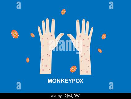 Illustrazione di lesioni cutanee o eruzioni cutanee sulle mani del paziente e sui virus della scimmia Illustrazione Vettoriale