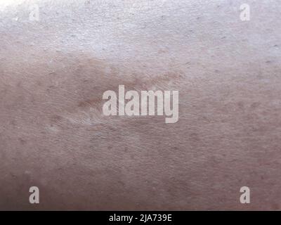 Primo piano, cicatrice guarita sulla pelle del corpo umano Foto Stock