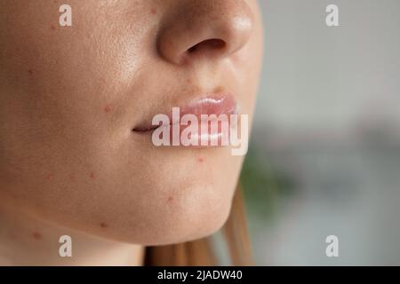 Closeup acne sul viso della donna con rash cutaneo fuoco selettivo Foto Stock