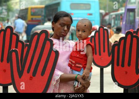 Una donna vittima di violenza acida. Il lancio di acido è una delle forme più viziose di violenza in Bangladesh. La maggior parte delle vittime sono donne. Le ragioni riportate per gli attacchi acidati includono il rifiuto di un'offerta di matrimonio, dispute di dote, lotte domestiche e dispute sulla proprietà. Dhaka, Bangladesh. Foto Stock