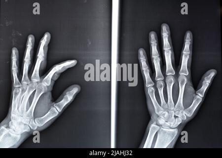 La radiografia piana mostra la base della frattura di avulsione della falanice distale del dito medio sinistro, la frattura di un piccolo pezzo di osso attaccato a un tendine o a Foto Stock