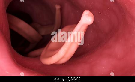 Illustrazione biomedica concettuale di lumbricoides di Ascaris nell'intestino umano. Foto Stock