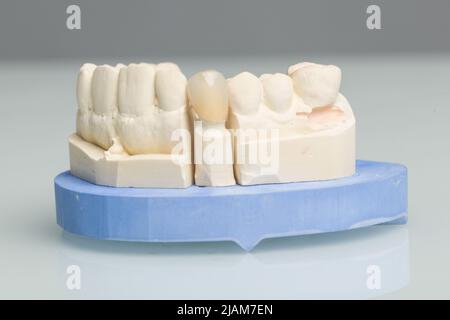primo piano della corona dentata o dell'impianto in laboratorio dentale Foto Stock