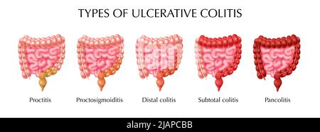 Colite ulcerosa tipi infografiche inclusa la proctitis colite distale pancolite proctosigmoidite colite subtotale illustrazione vettoriale realistica Illustrazione Vettoriale