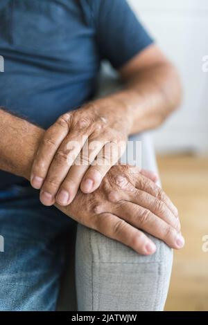 Uomo anziano affetto da psoriasi, primo piano sulle mani Foto Stock