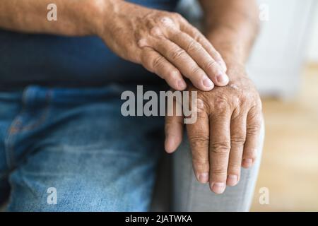 Uomo anziano affetto da psoriasi, primo piano sulle mani Foto Stock