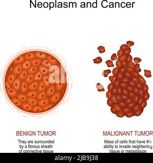 Neoplasia e cancro. Confronto e differenza di un tumore maligno e benigno tumore benigno circondato da una guaina fibrosa del tessuto connettivo Illustrazione Vettoriale