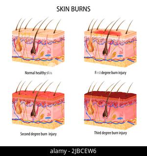 Insieme realistico di normale e tre gradi di ustioni struttura della pelle isolato su sfondo bianco illustrazione vettoriale Illustrazione Vettoriale