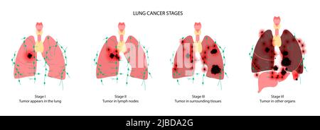 Cancro ai polmoni, illustrazione Foto Stock
