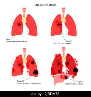Cancro ai polmoni, illustrazione Foto Stock