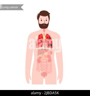 Cancro ai polmoni, illustrazione Foto Stock